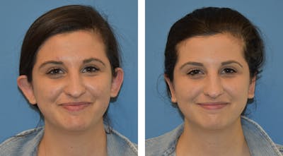 Ear Surgery/Otoplasty Before & After Gallery - Patient 49633410 - Image 1