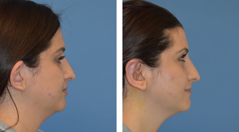 Ear Surgery/Otoplasty Before & After Gallery - Patient 49633410 - Image 2