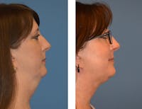 FaceTite Before & After Gallery - Patient 49633558 - Image 1