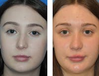 Deviated Nose Before & After Gallery - Patient 49634210 - Image 1