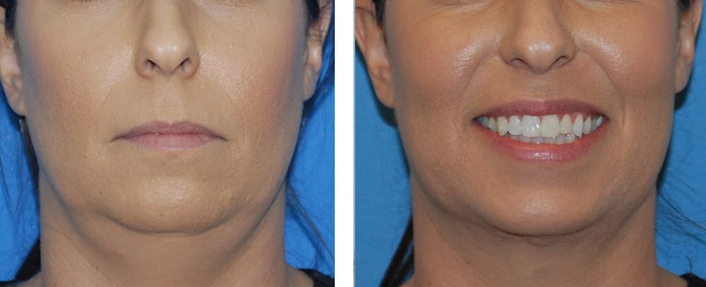 Neck Liposuction Before & After Gallery - Patient 122446663 - Image 1