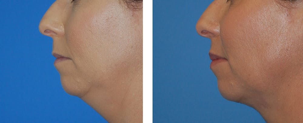 Neck Liposuction Before & After Gallery - Patient 122446663 - Image 2