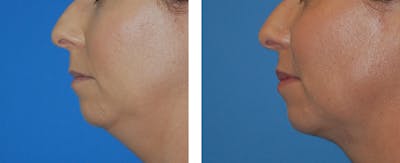 FaceTite Before & After Gallery - Patient 122446662 - Image 2