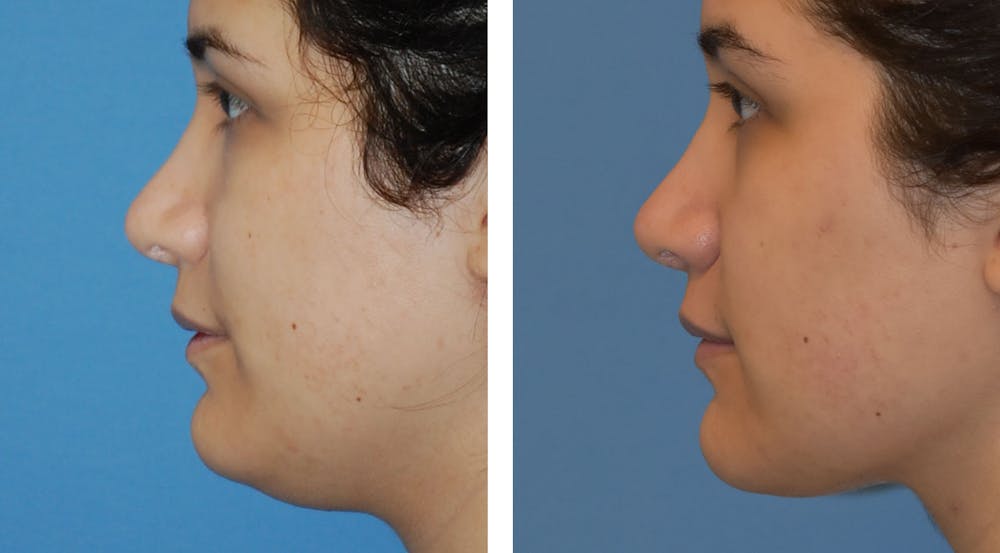 Neck Liposuction Before & After Gallery - Patient 122446665 - Image 1