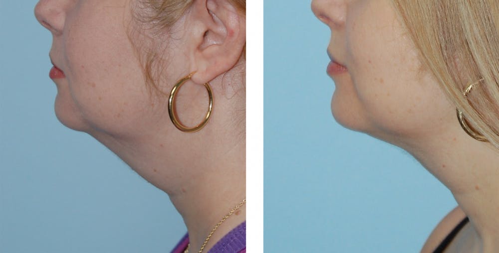 Neck Liposuction Before & After Gallery - Patient 122446671 - Image 1
