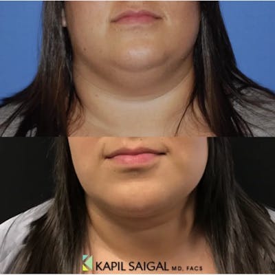 FaceTite Before & After Gallery - Patient 122446675 - Image 1