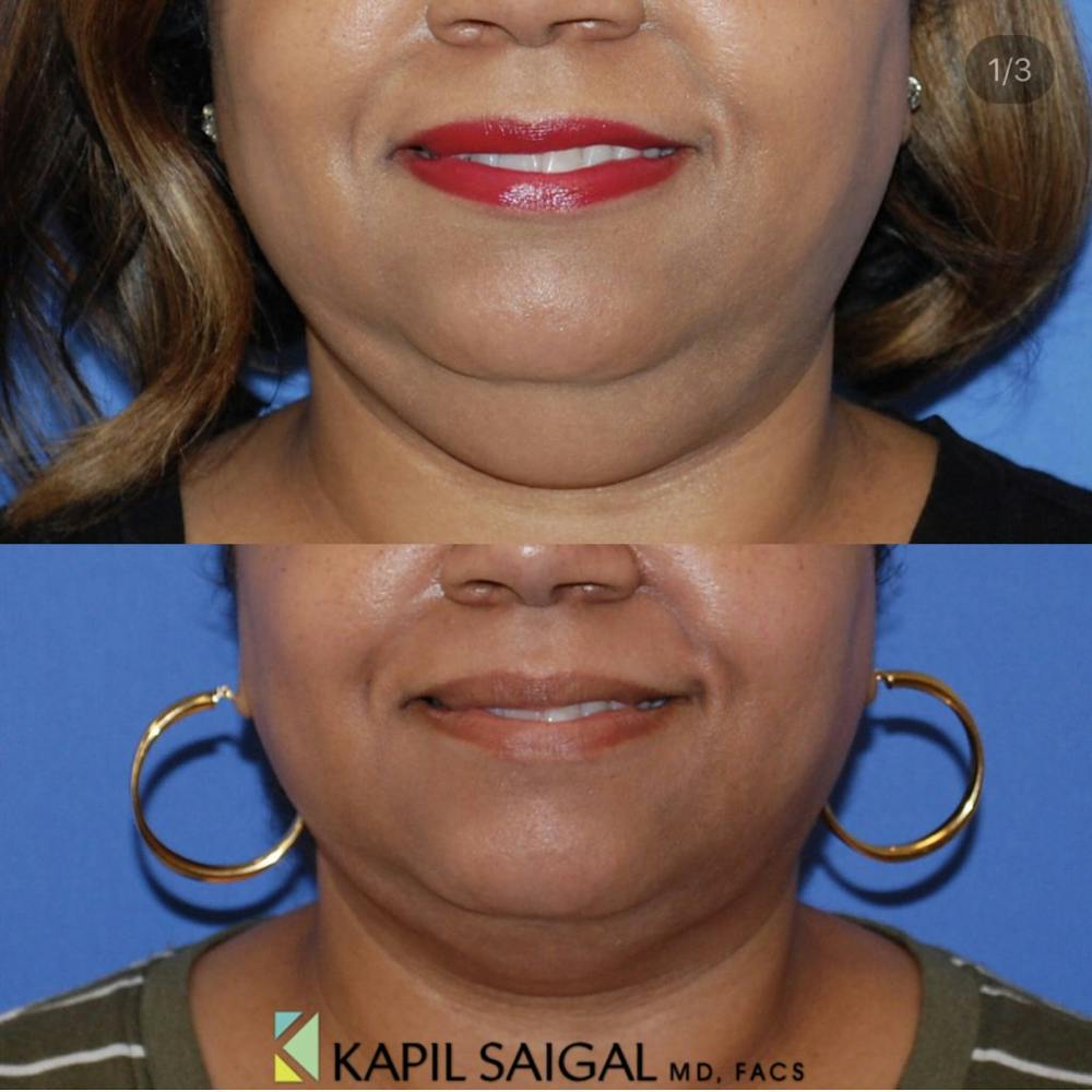 Neck Liposuction Before & After Gallery - Patient 122446679 - Image 1