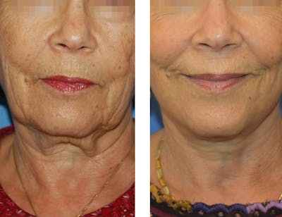 Facelift & Neck Lift Before & After Gallery - Patient 122446795 - Image 2