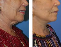 Facelift & Neck Lift Before & After Gallery - Patient 122446795 - Image 1