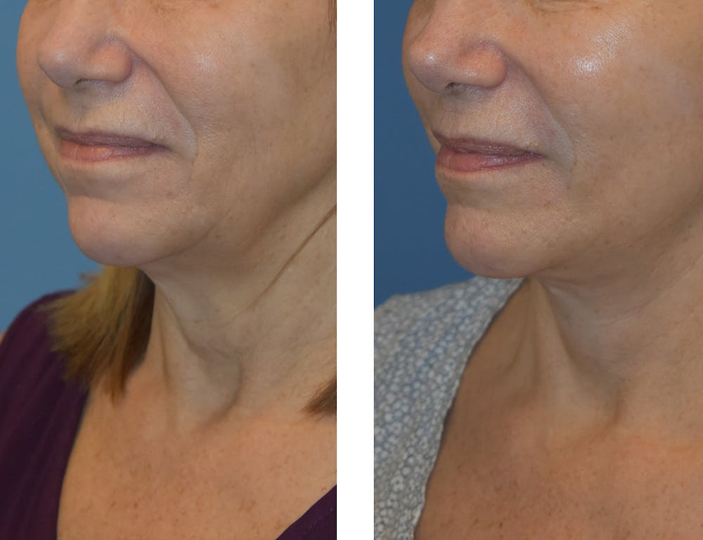Facelift & Neck Lift Before & After Gallery - Patient 122446837 - Image 1