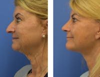 Facelift & Neck Lift Before & After Gallery - Patient 122446849 - Image 1