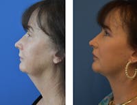 Facelift & Neck Lift Before & After Gallery - Patient 122446871 - Image 1