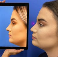 Rhinoplasty Before & After Gallery - Patient 157104169 - Image 1