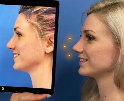 Rhinoplasty Before & After Gallery - Patient 157104219 - Image 1