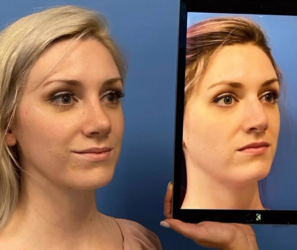 Rhinoplasty Before & After Gallery - Patient 157104219 - Image 2