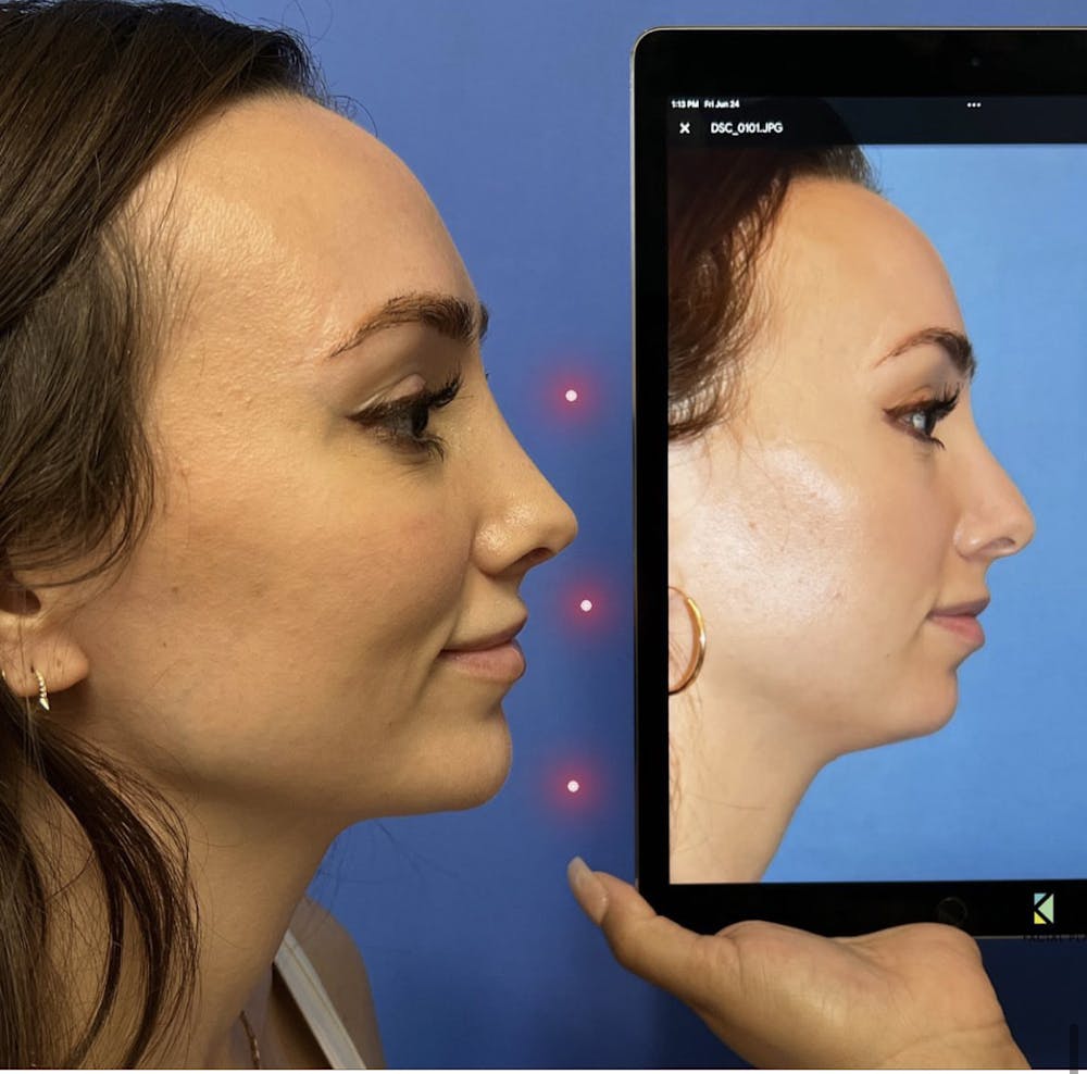 Chin Augmentation Before & After Gallery - Patient 157104286 - Image 1