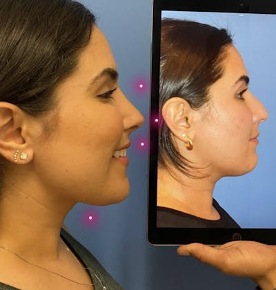 Rhinoplasty Before & After Gallery - Patient 157171580 - Image 1