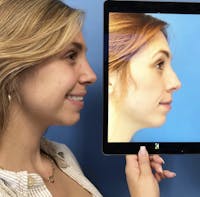 Rhinoplasty Before & After Gallery - Patient 157171601 - Image 1