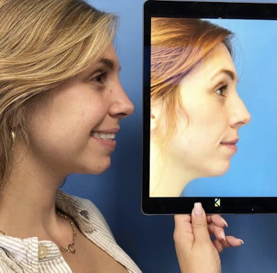 Rhinoplasty Before & After Gallery - Patient 157171601 - Image 1