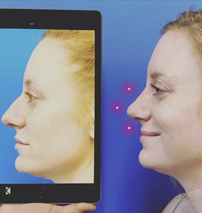 Rhinoplasty Before & After Gallery - Patient 157171604 - Image 1