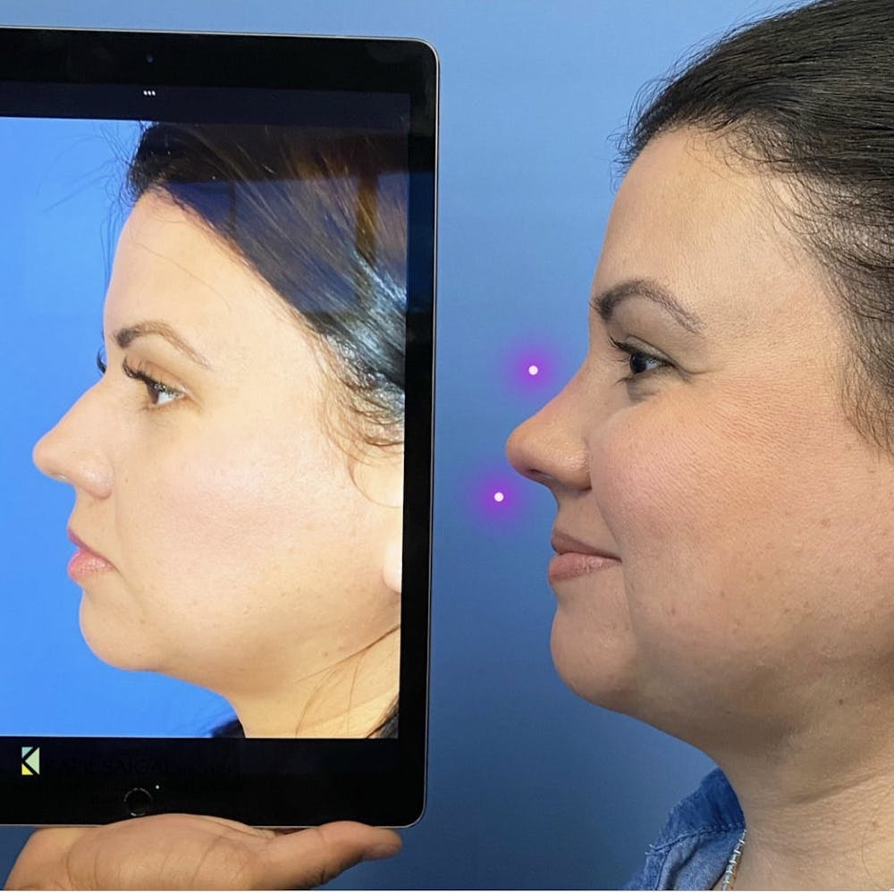 Rhinoplasty Before & After Gallery - Patient 157171615 - Image 1