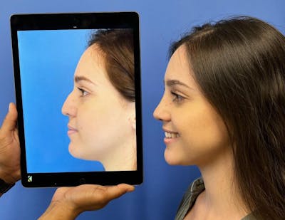 Rhinoplasty Before & After Gallery - Patient 157171620 - Image 1