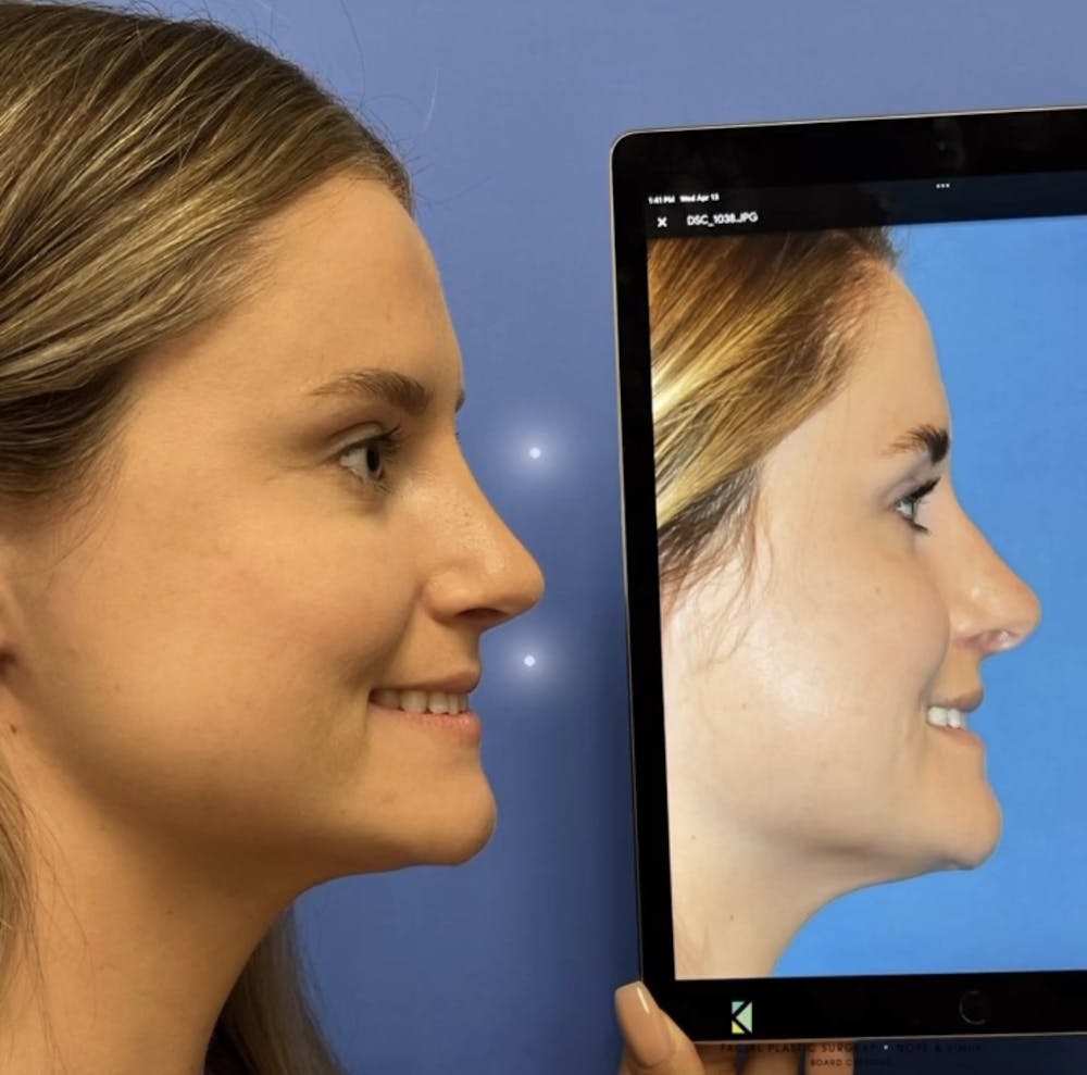 Rhinoplasty Before & After Gallery - Patient 157171632 - Image 1