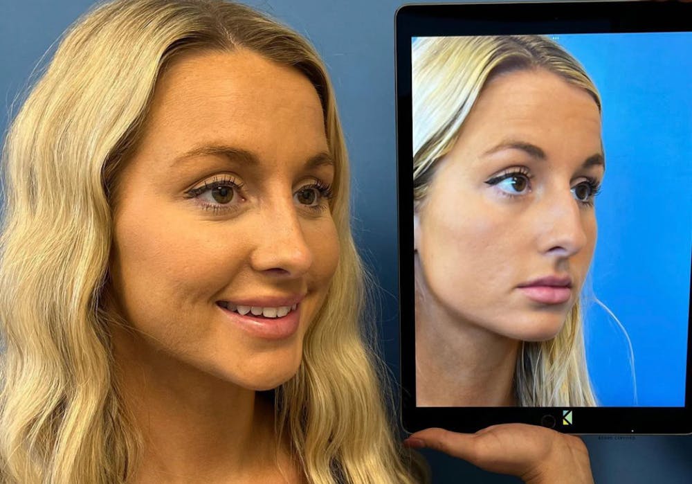 Rhinoplasty Before & After Gallery - Patient 157171639 - Image 2