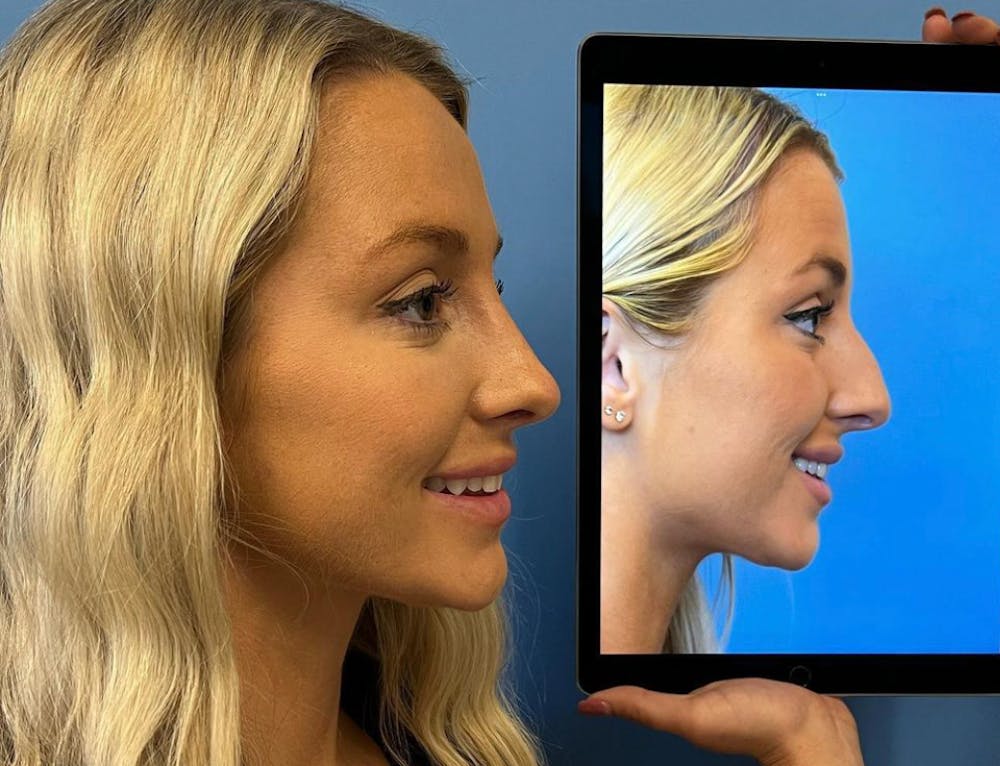 Rhinoplasty Before & After Gallery - Patient 157171639 - Image 1