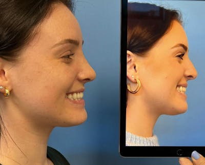 Rhinoplasty Before & After Gallery - Patient 157171644 - Image 1