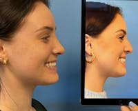 Rhinoplasty Before & After Gallery - Patient 157171644 - Image 1