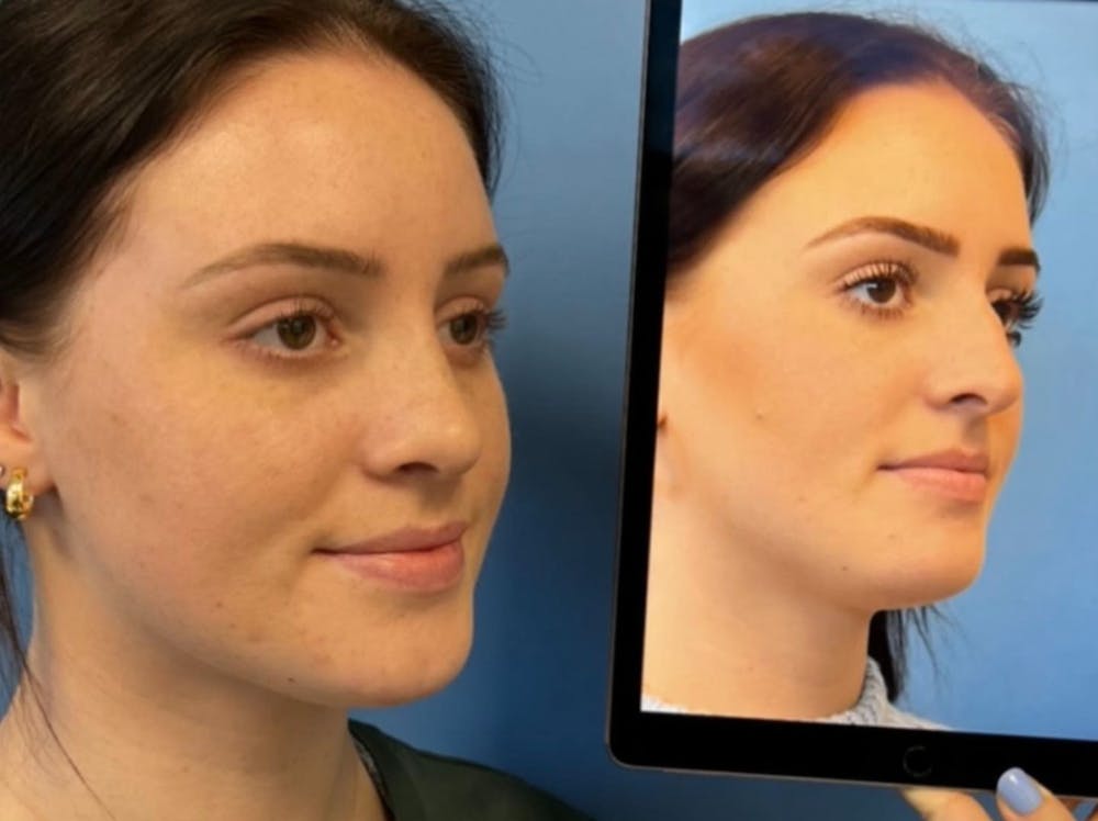 Rhinoplasty Before & After Gallery - Patient 157171644 - Image 2