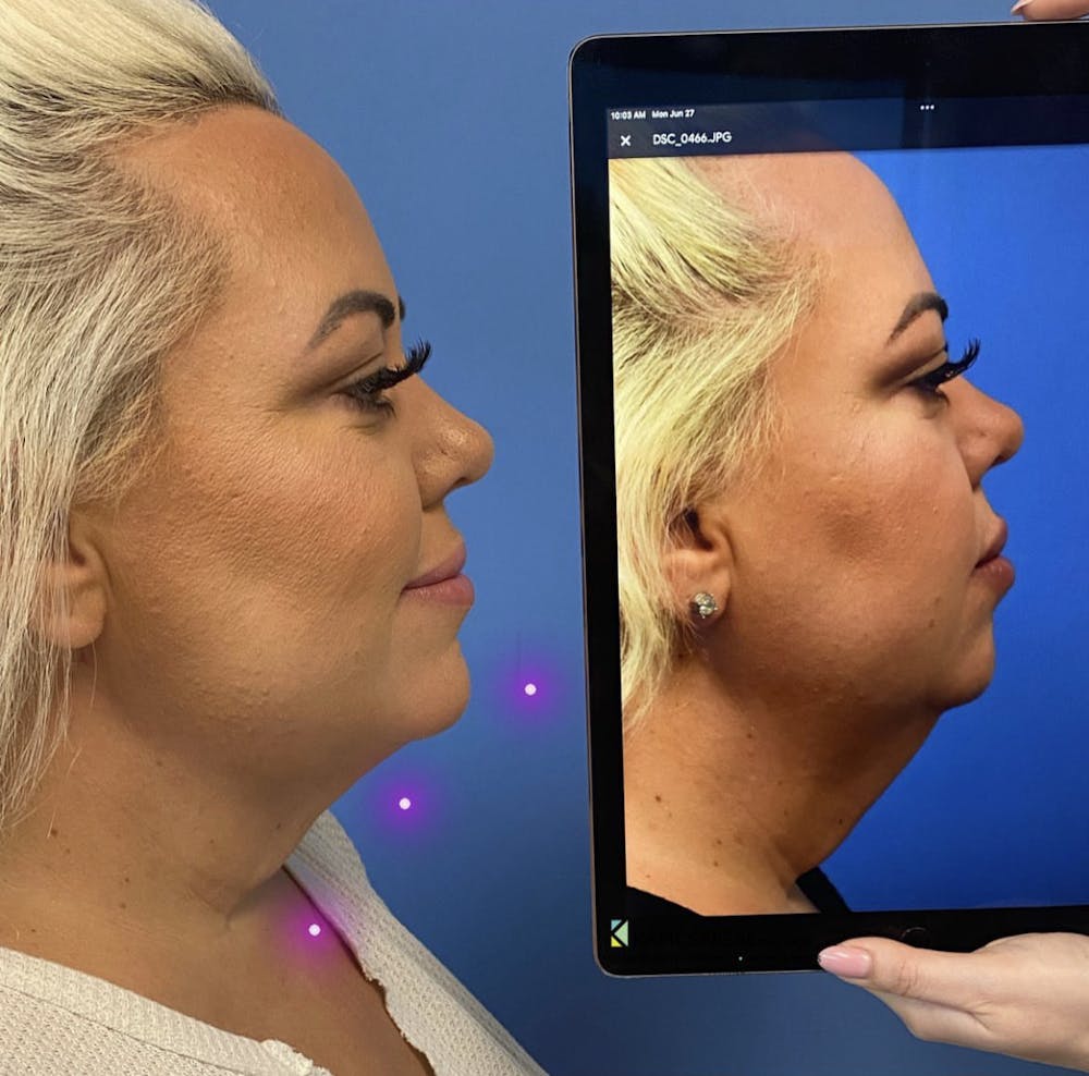 Chin Augmentation Before & After Gallery - Patient 403780 - Image 1