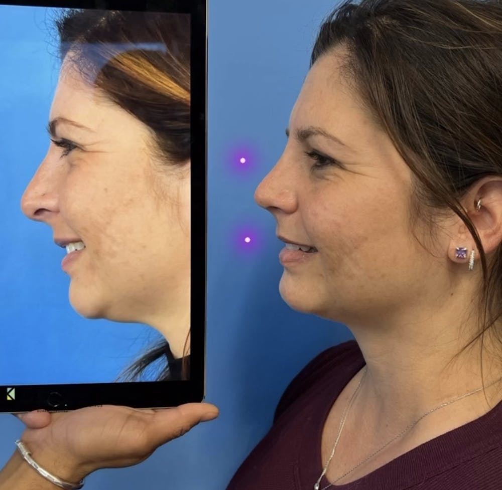 Rhinoplasty Before & After Gallery - Patient 389619 - Image 1