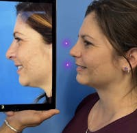 Rhinoplasty Before & After Gallery - Patient 389619 - Image 1