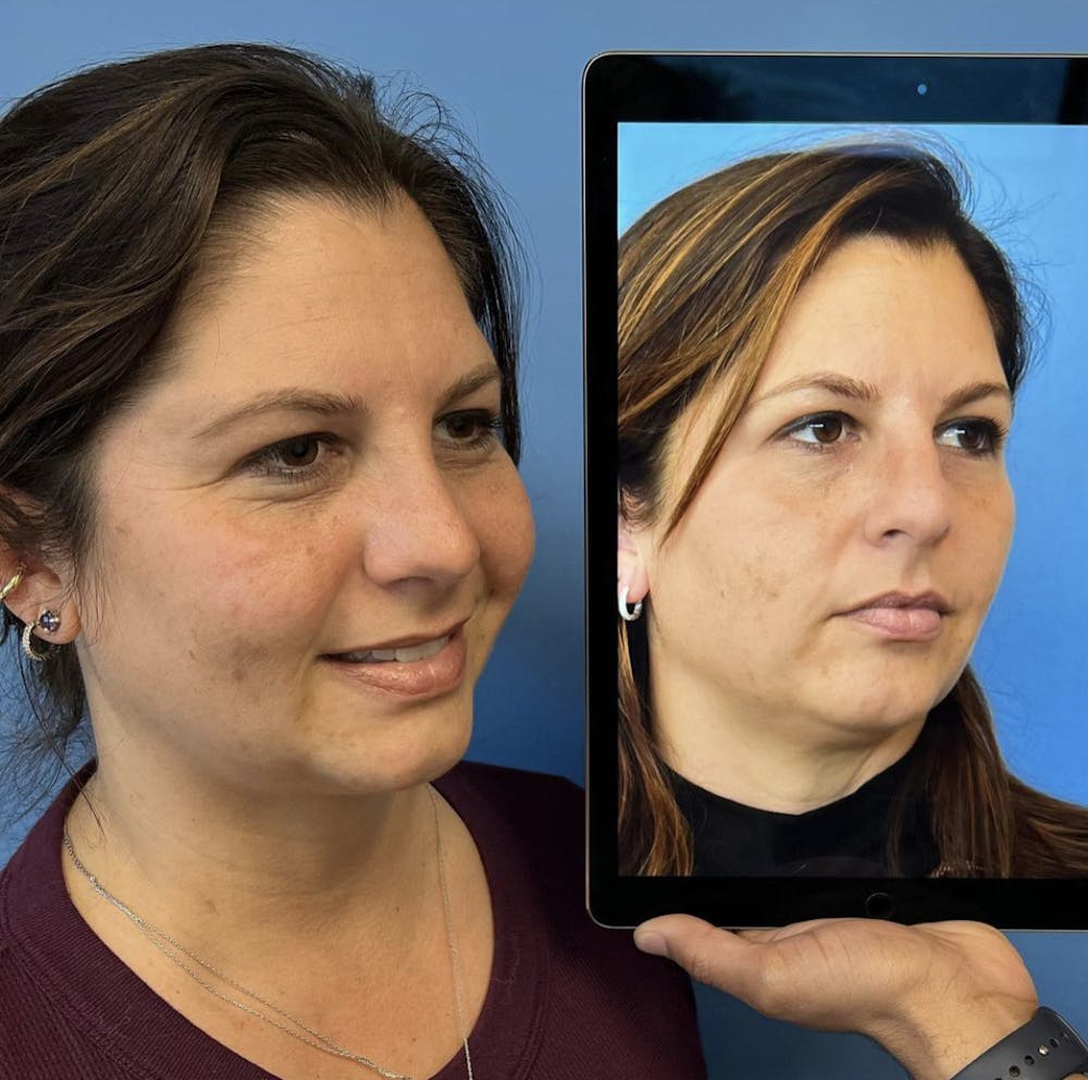 Rhinoplasty Before & After Gallery - Patient 389619 - Image 2