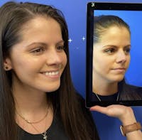 Rhinoplasty Before & After Gallery - Patient 288114 - Image 1