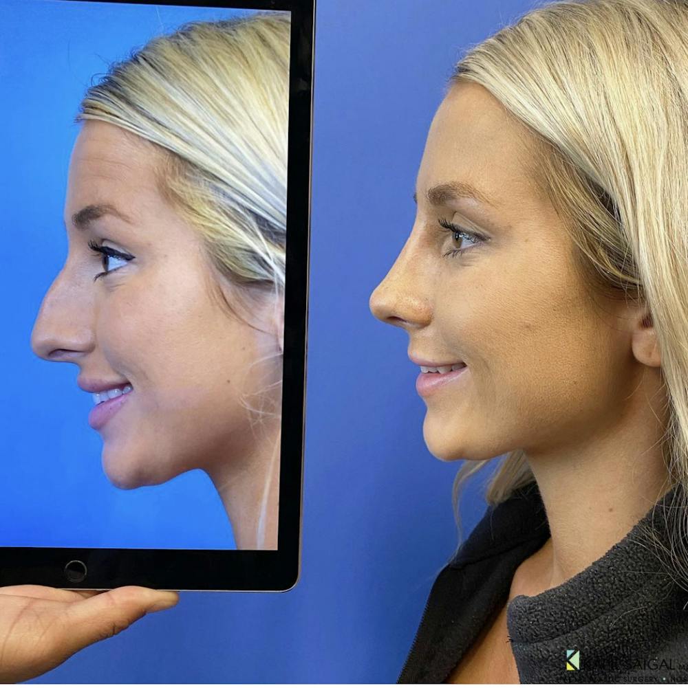 Rhinoplasty Before & After Gallery - Patient 157171639 - Image 3