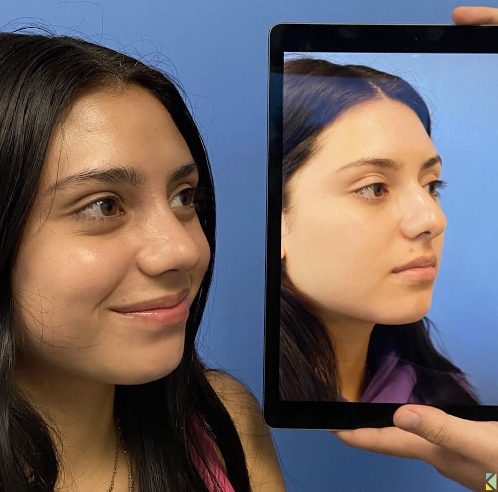 Rhinoplasty Before & After Gallery - Patient 401308 - Image 1