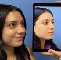 Rhinoplasty Before & After Gallery - Patient 401308 - Image 1