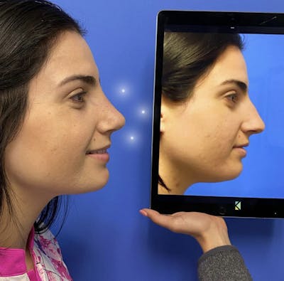 Rhinoplasty Before & After Gallery - Patient 349977 - Image 1