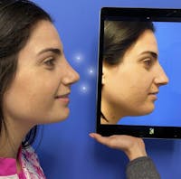 Rhinoplasty Before & After Gallery - Patient 349977 - Image 1