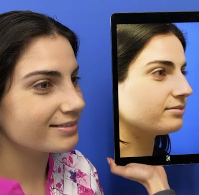 Rhinoplasty Before & After Gallery - Patient 349977 - Image 2