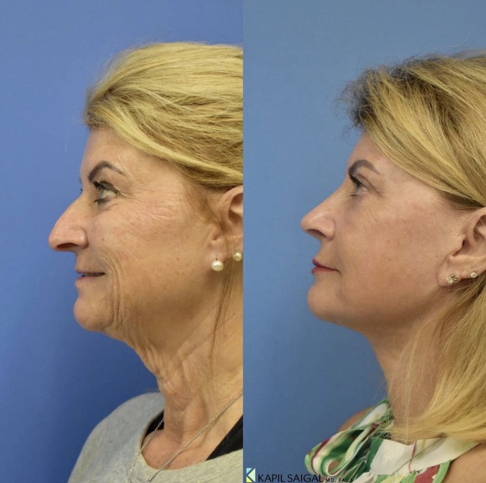 Facelift & Neck Lift Before & After Gallery - Patient 122446849 - Image 3