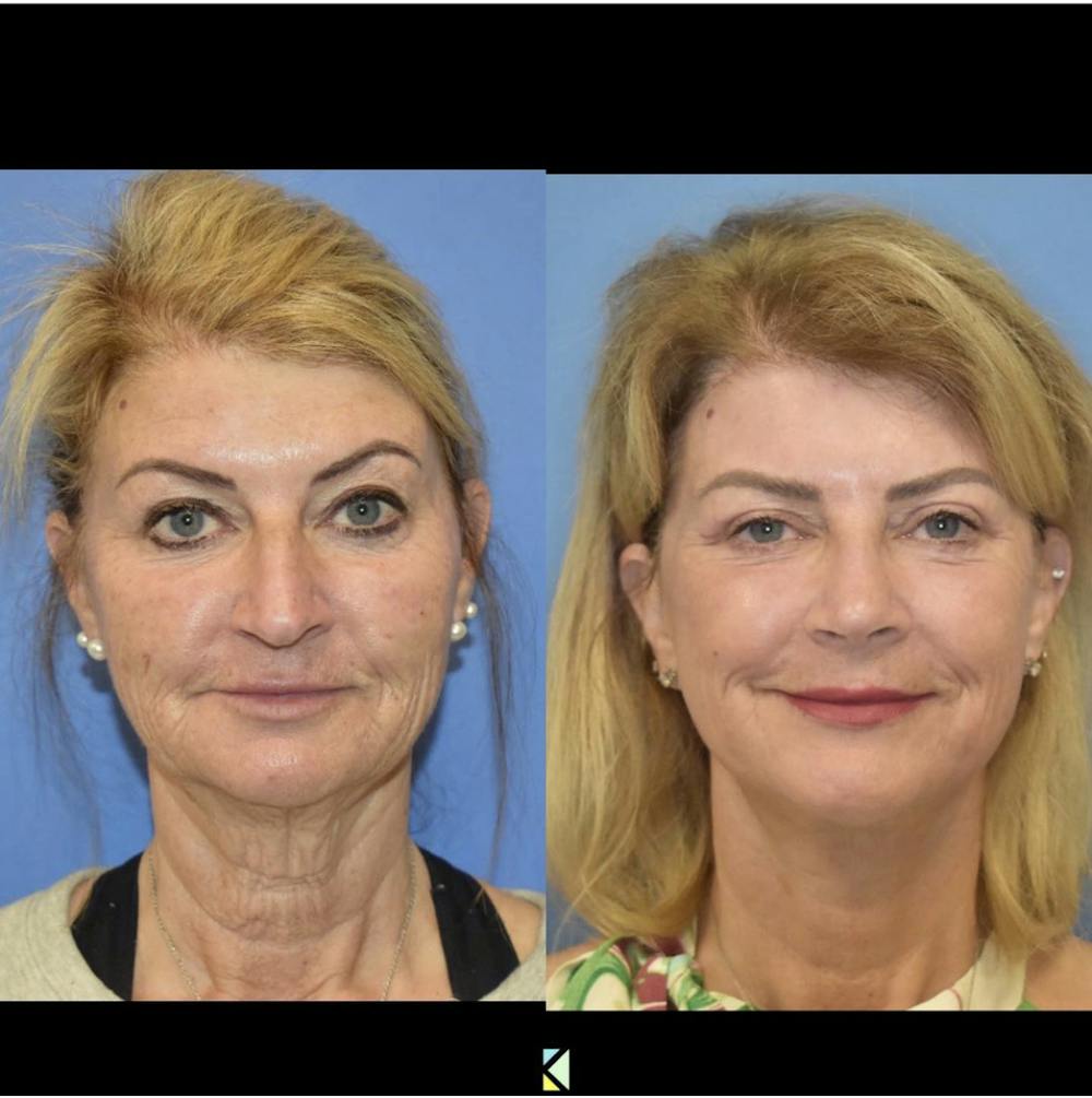 Facelift & Neck Lift Before & After Gallery - Patient 122446849 - Image 2