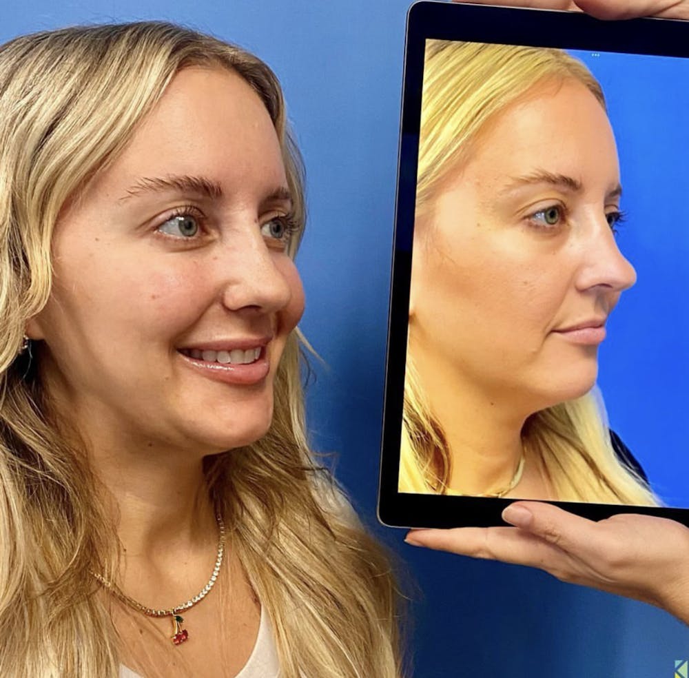 Rhinoplasty Before & After Gallery - Patient 320149 - Image 1