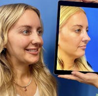 Rhinoplasty Before & After Gallery - Patient 320149 - Image 1
