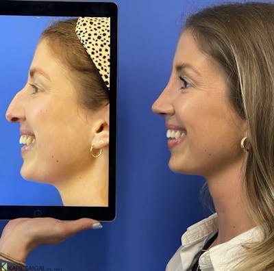 Rhinoplasty Before & After Gallery - Patient 878423 - Image 2
