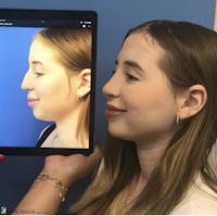 Rhinoplasty Before & After Gallery - Patient 334180 - Image 1