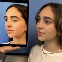 Rhinoplasty Before & After Gallery - Patient 316647 - Image 1